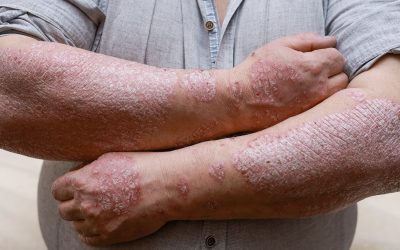 Johnson & Johnson y su innovador tratamiento de la psoriasis
