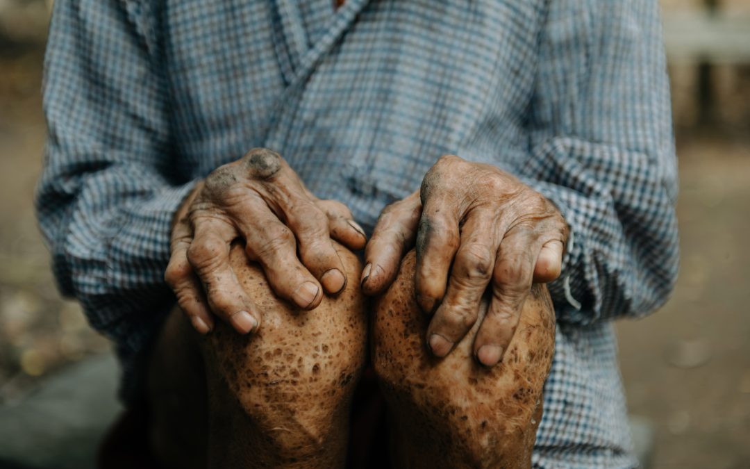 Chile: Primer país en erradicar la Hanseniasis en las Américas